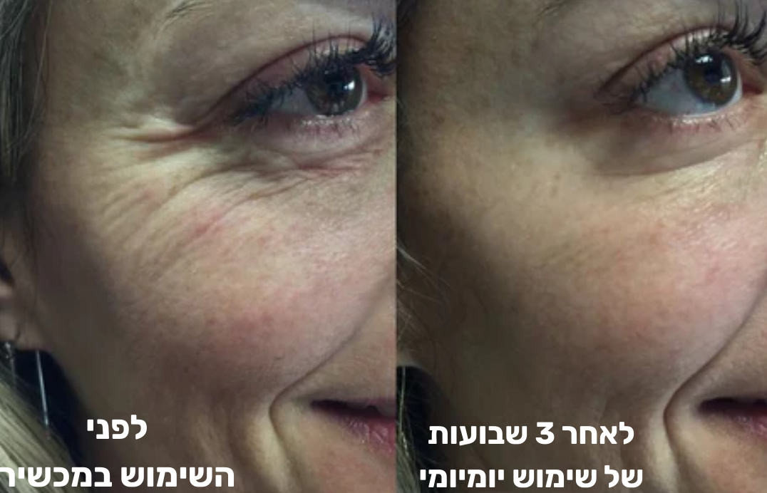 GlowFace - מכשיר למיצוק עור הפנים והפחתת קמטים