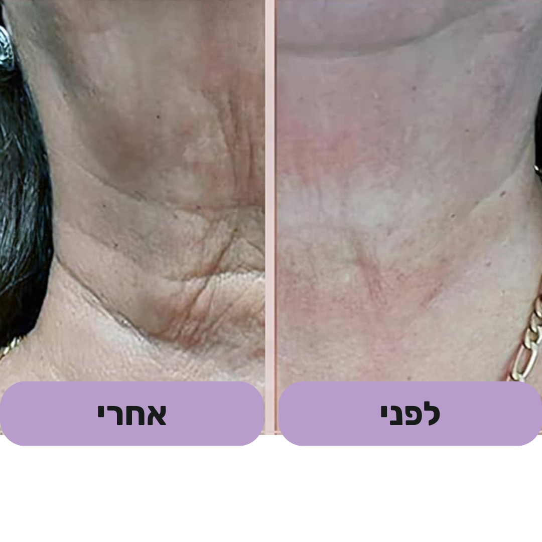 GlowFace - מכשיר למיצוק עור הפנים והפחתת קמטים