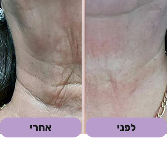 GlowFace - מכשיר למיצוק עור הפנים והפחתת קמטים